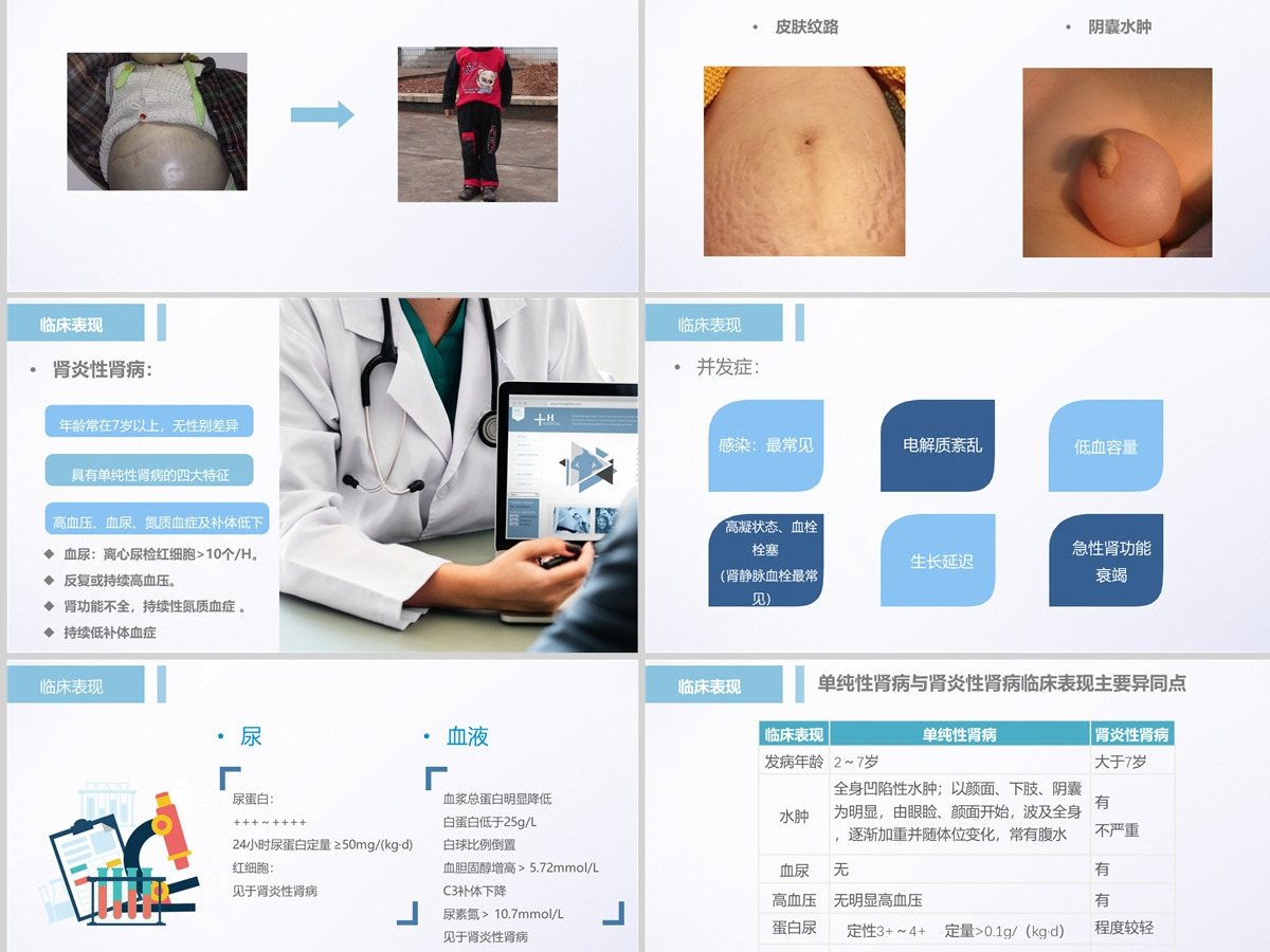 2022肾病综合征护理查房清新创意护理查房通用PPT 2022肾病综合征护理查房清新创意护理查房通用PPT