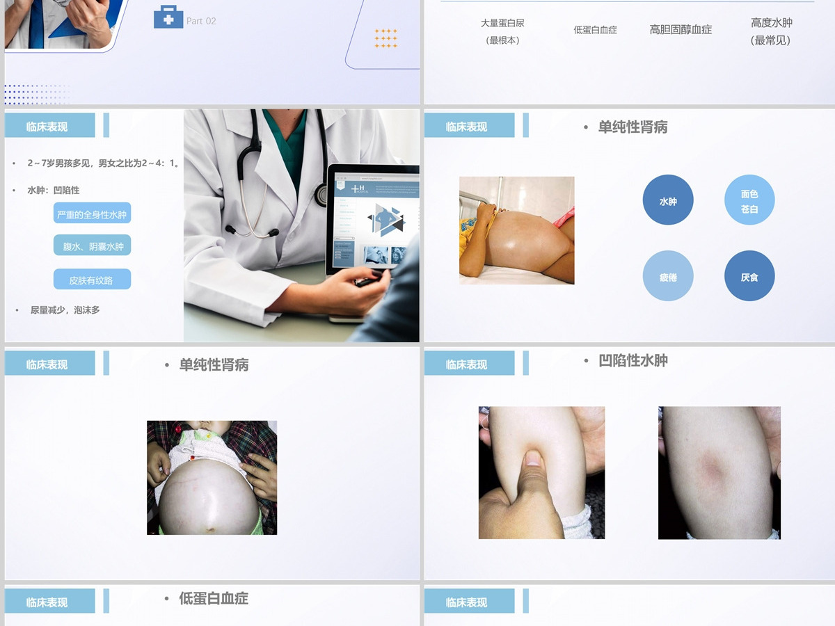 2022肾病综合征护理查房清新创意护理查房通用PPT 2022肾病综合征护理查房清新创意护理查房通用PPT