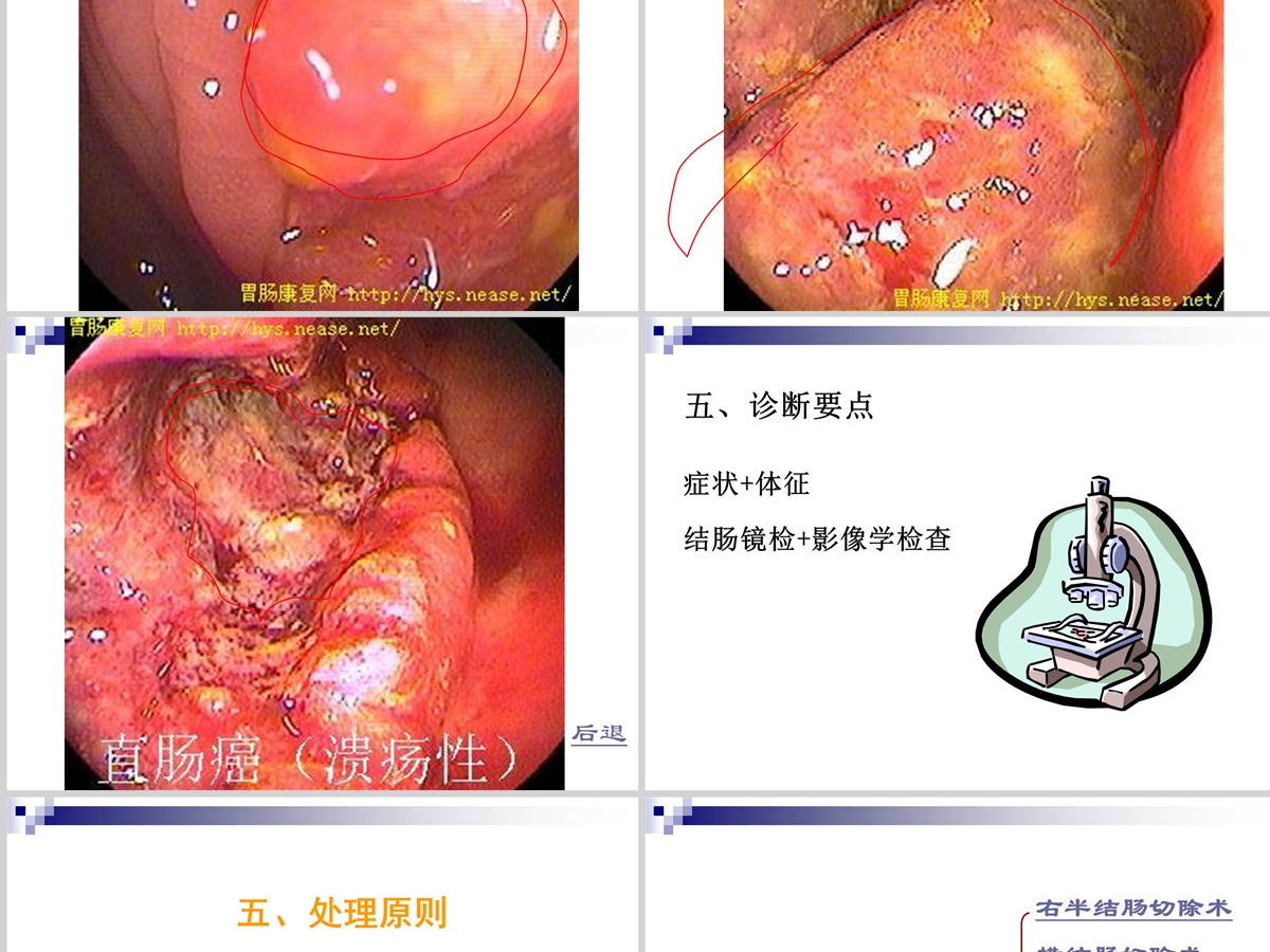 结肠癌直肠癌患者的护理护理查房PPT 结肠癌直肠癌患者的护理护理查房PPT