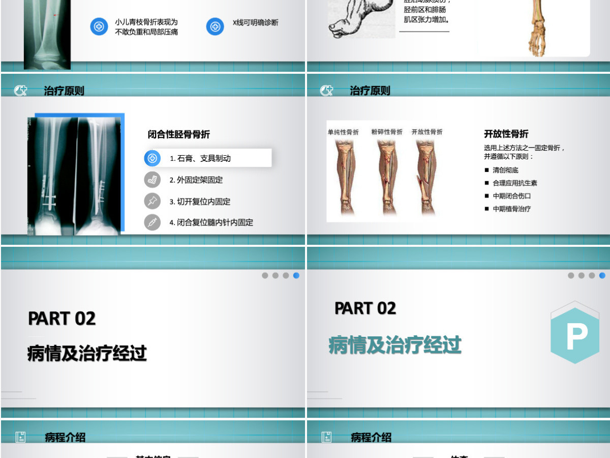 2022胫腓骨骨折护理简约个性医学护理通用PPT 2022胫腓骨骨折护理简约个性医学护理通用PPT