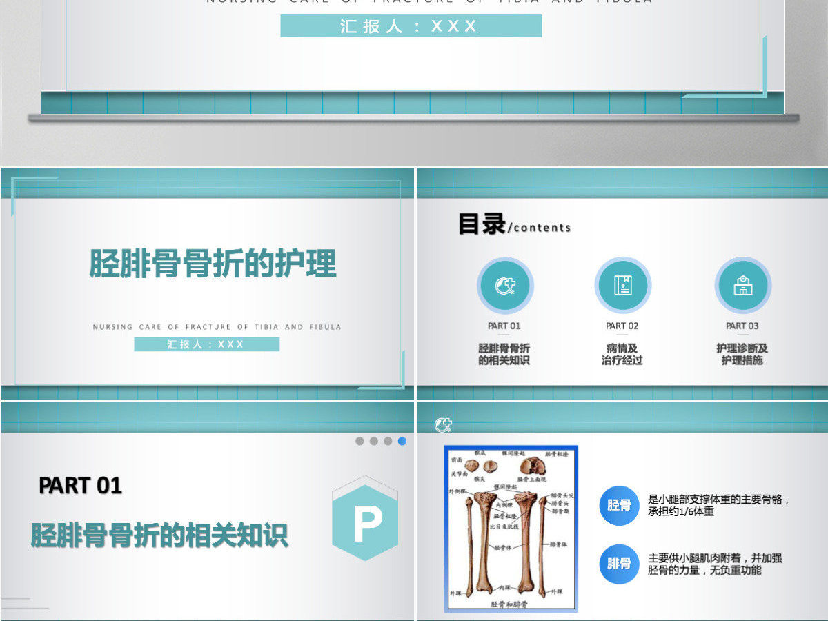 2022胫腓骨骨折护理简约个性医学护理通用PPT 2022胫腓骨骨折护理简约个性医学护理通用PPT