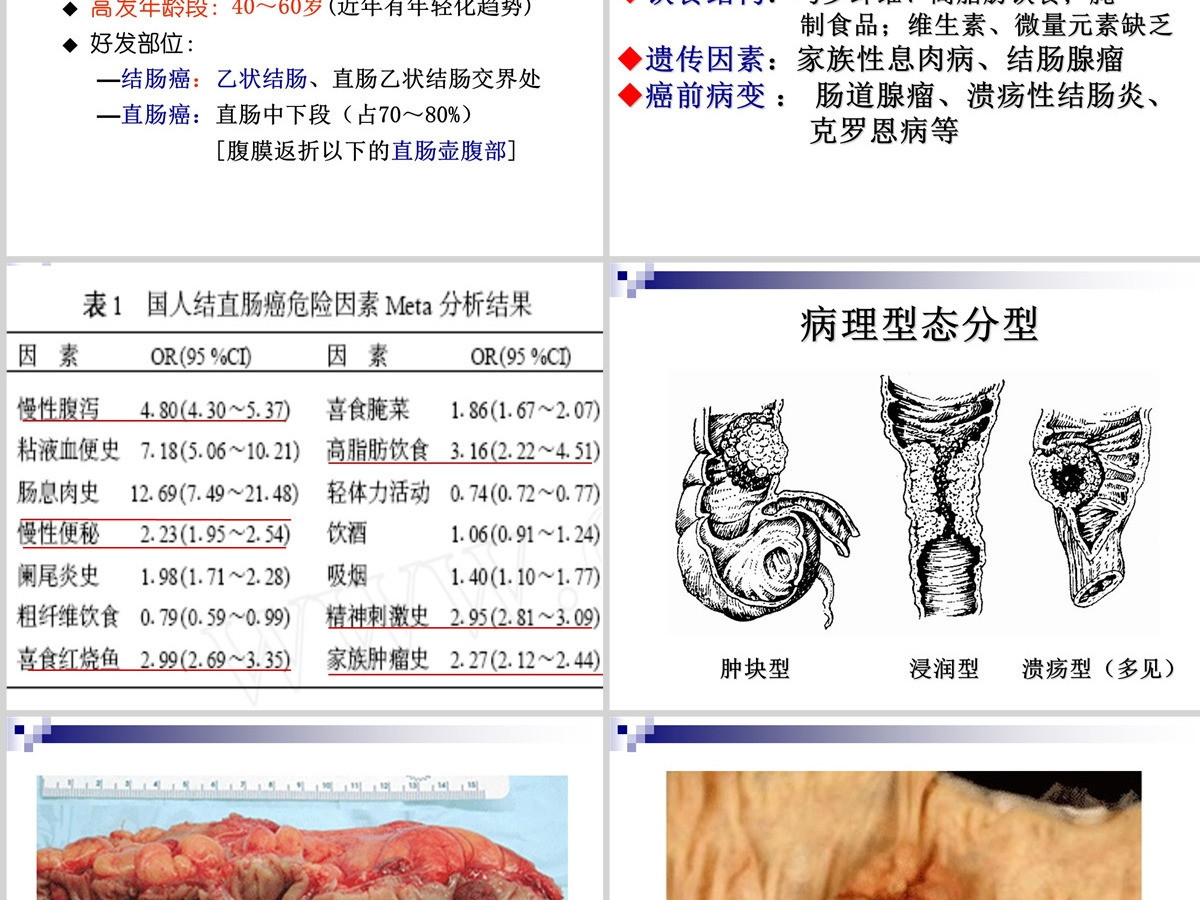 结肠癌直肠癌患者的护理护理查房PPT 结肠癌直肠癌患者的护理护理查房PPT