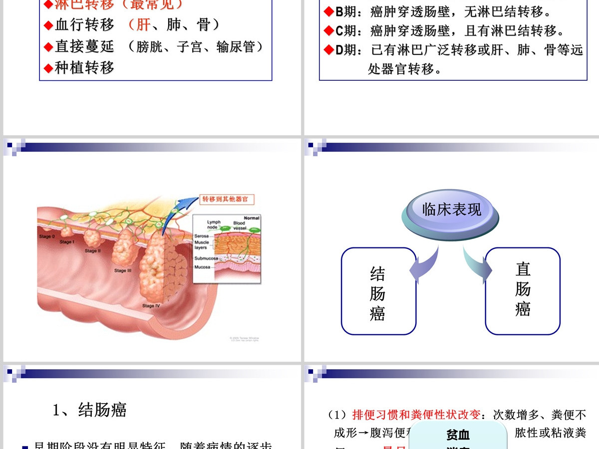 结肠癌直肠癌患者的护理护理查房PPT 结肠癌直肠癌患者的护理护理查房PPT