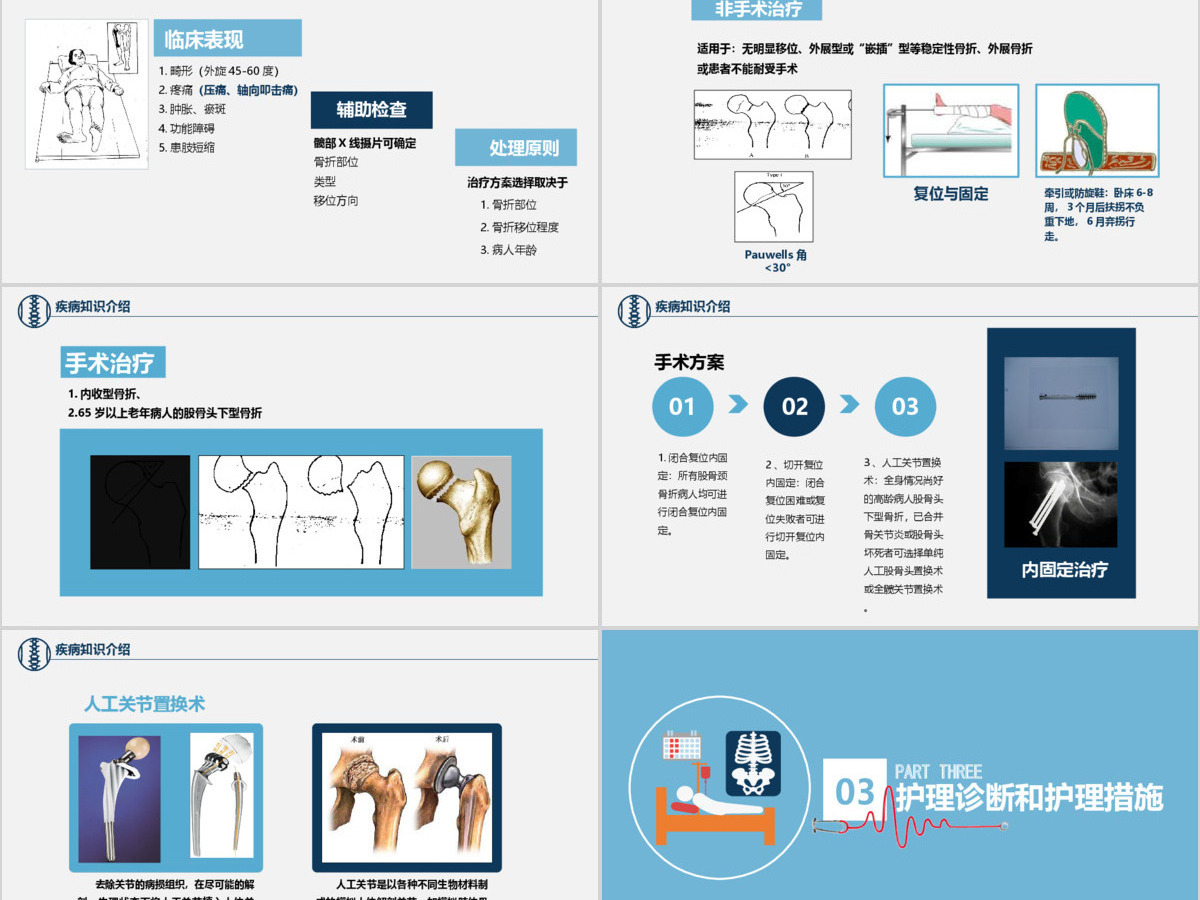 股骨颈骨折护理查房ppt 股骨颈骨折护理查房ppt