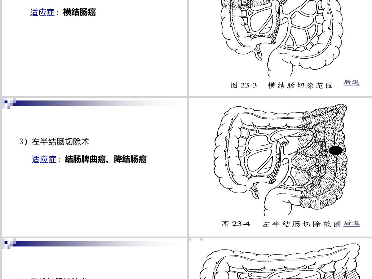 结肠癌直肠癌患者的护理护理查房PPT 结肠癌直肠癌患者的护理护理查房PPT