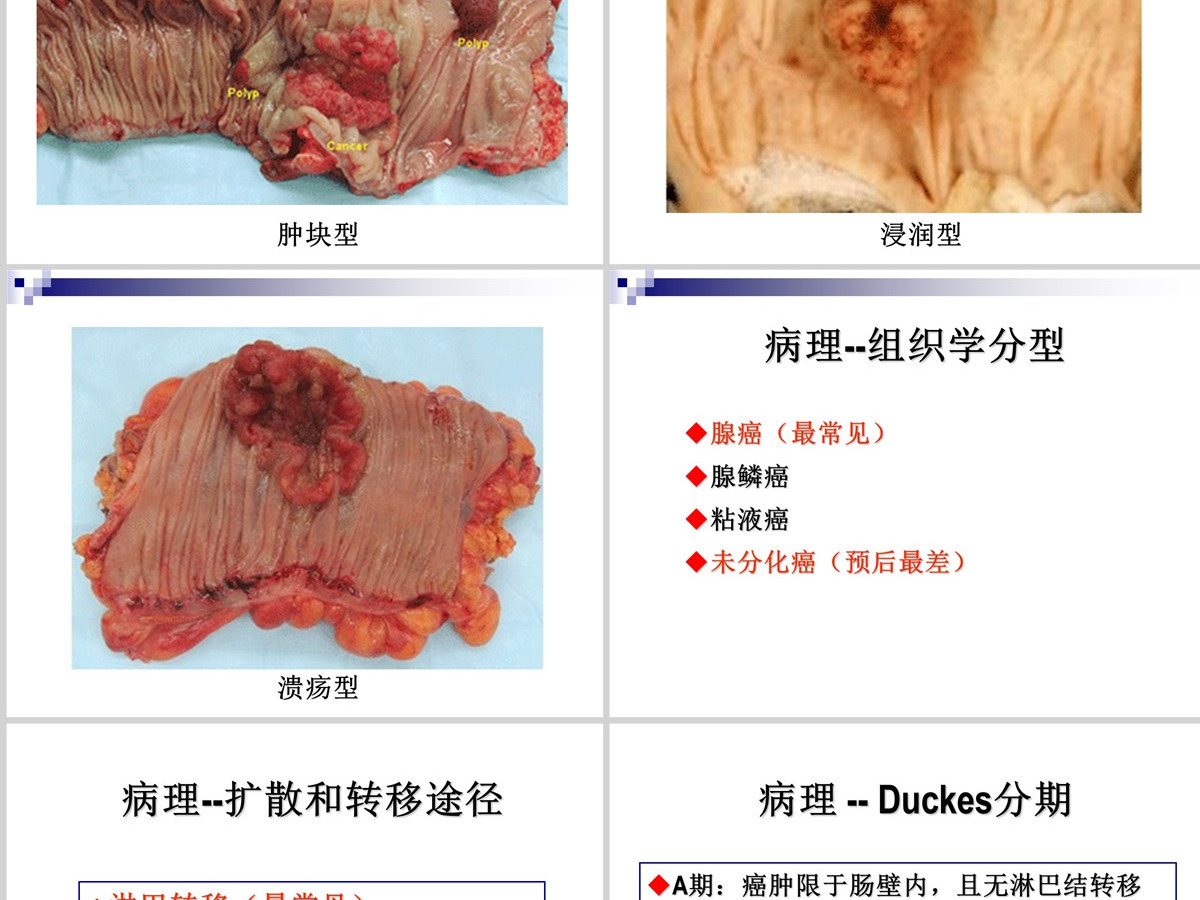 结肠癌直肠癌患者的护理护理查房PPT 结肠癌直肠癌患者的护理护理查房PPT