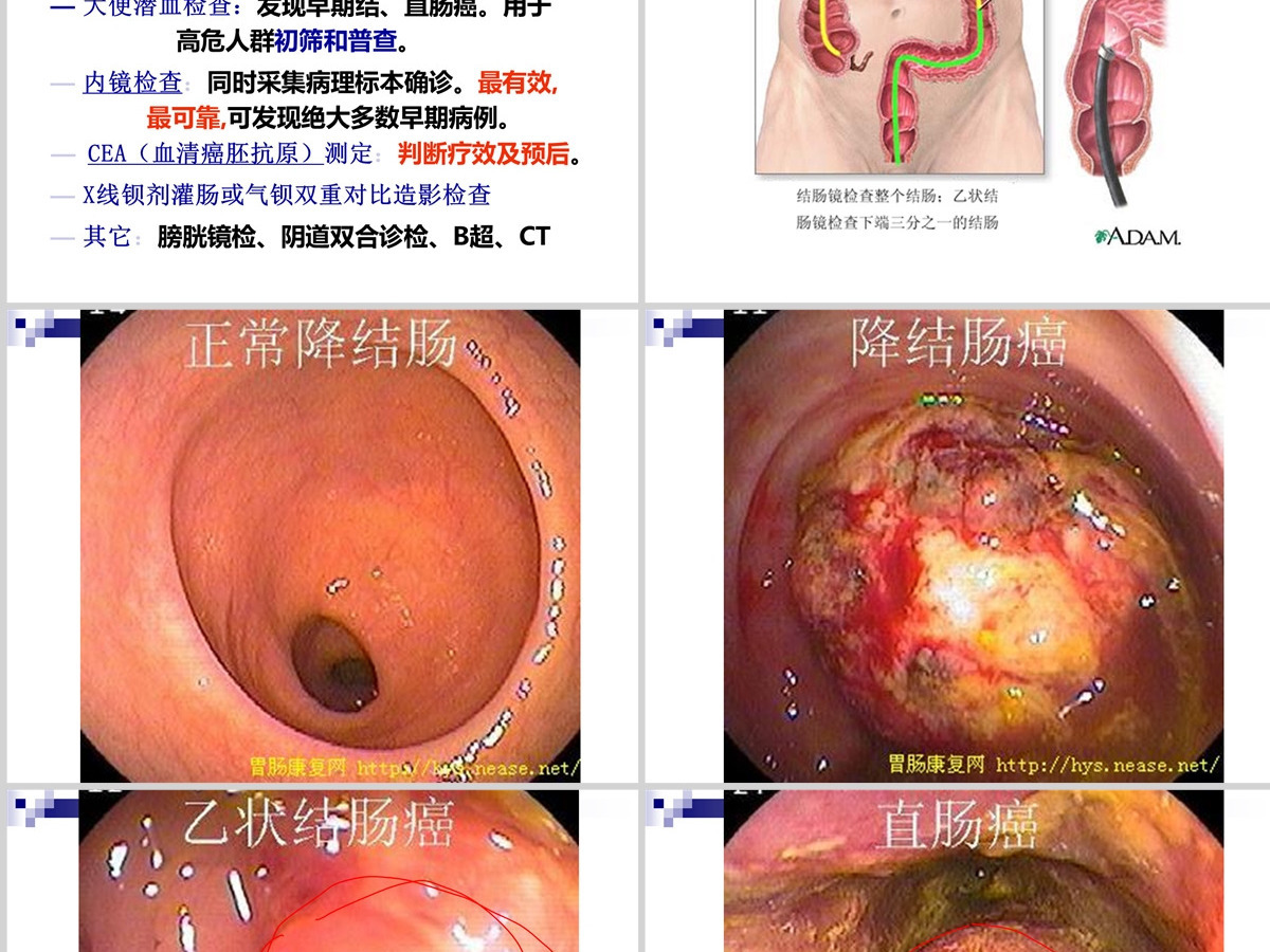 结肠癌直肠癌患者的护理护理查房PPT 结肠癌直肠癌患者的护理护理查房PPT