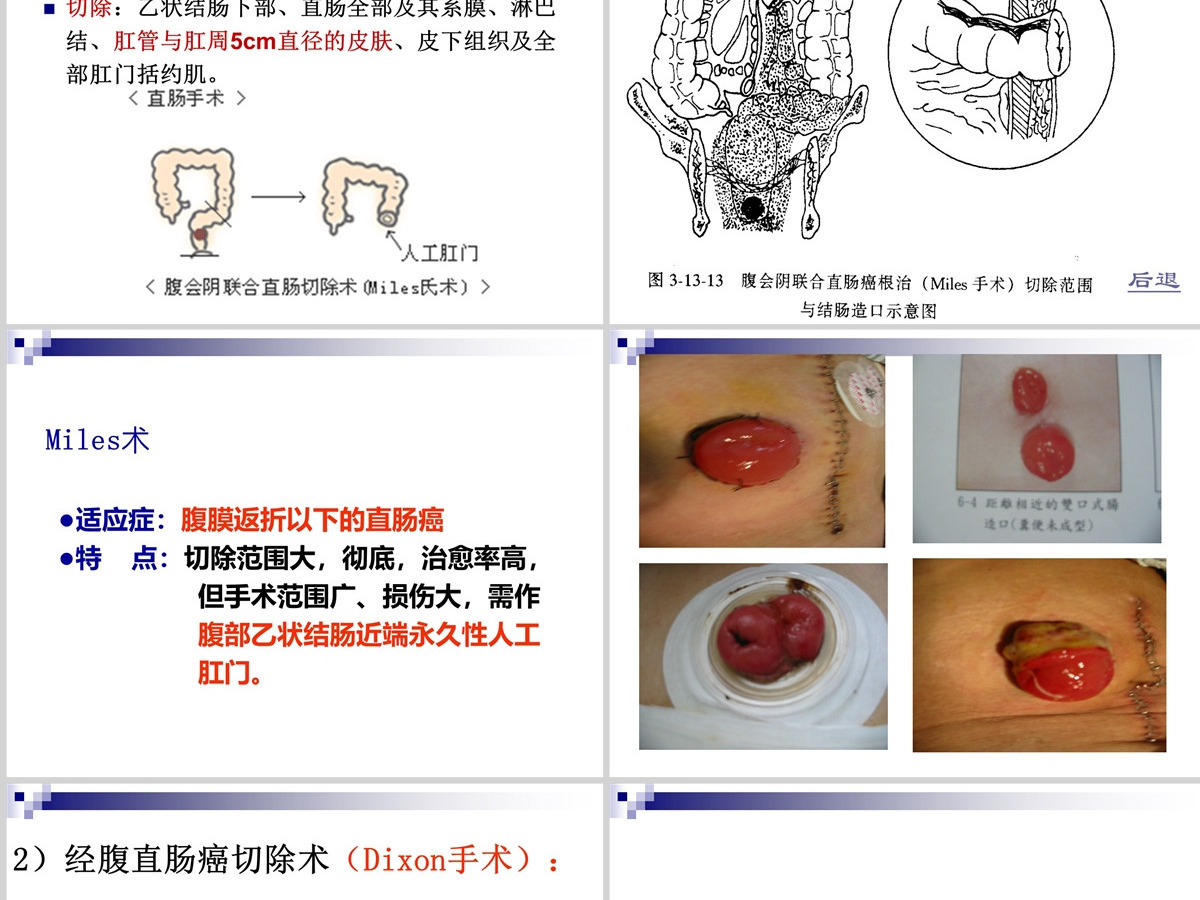 结肠癌直肠癌患者的护理护理查房PPT 结肠癌直肠癌患者的护理护理查房PPT
