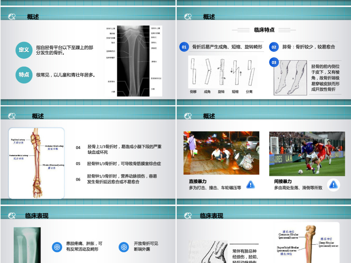 2022胫腓骨骨折护理简约个性医学护理通用PPT 2022胫腓骨骨折护理简约个性医学护理通用PPT
