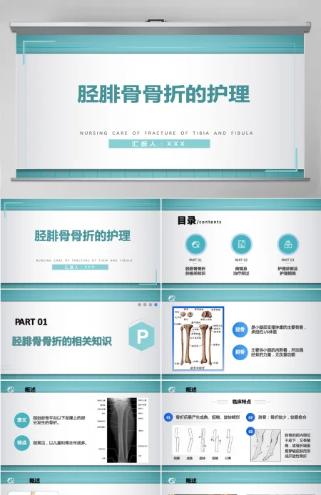 2022胫腓骨骨折护理简约个性医学护理通用PPT